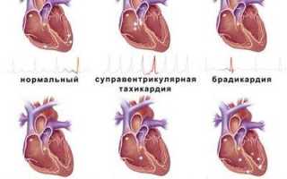 Полная блокада сердца что это такое