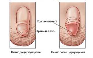 Операция по удалению крайней плоти