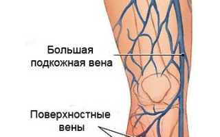 Тромбофлебит вен нижних конечностей