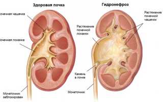 Основные причины расширения лоханки почки