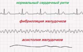 Внезапная остановка сердца причины и признаки
