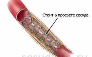 Реабилитация после стентирования сосудов сердца