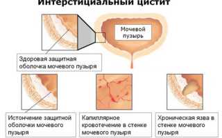 Урологические заболевания у мужчин и женщин: симптомы, лечение