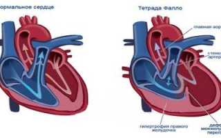 Порок сердца у детей симптомы