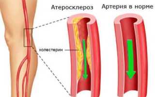 Облитерирующий атеросклероз сосудов нижних конечностей лечение