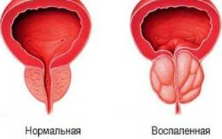 Часто хочется в туалет по-маленькому: почему и как лечить?