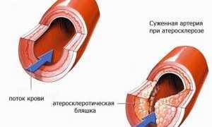 Уплотнение корня аорты