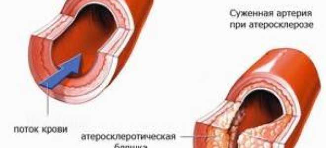 Уплотнение корня аорты