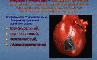 Обширный инфаркт что это