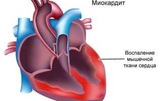 Политопная экстрасистолия
