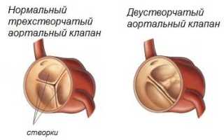Аортальный порок
