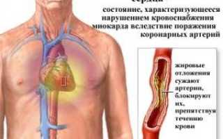 Сердечные заболевания список