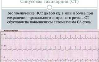 Синусовая тахикардия у ребенка
