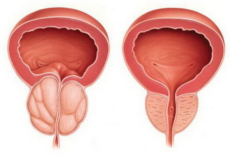 prostatit_1525992234_5af4cb2a65003