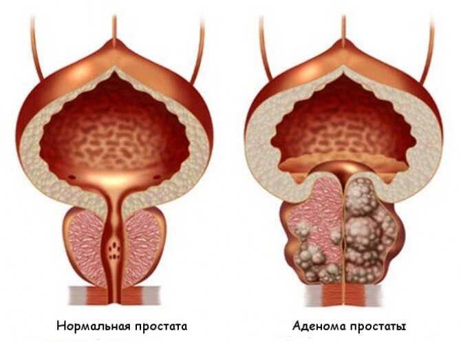 adenoma_prostaty_1525992558_5af4cc6e16410