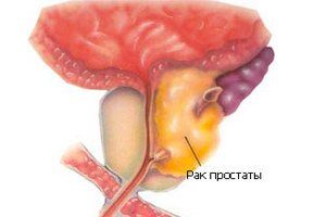 rak_prostaty_1525992679_5af4cce71aa9d